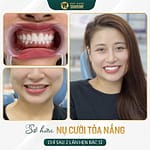 Chi phí niềng răng 1 hàm: Nên biết điều gì?
