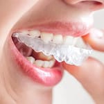 Ai phù hợp với niềng răng trong suốt và giá ra sao?