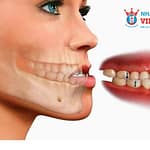 Bị móm có thể niềng răng được không? Tìm hiểu ngay