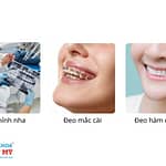 Niềng răng hô gồm những giai đoạn nào?