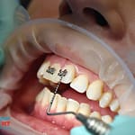 Niềng răng bao lâu mới tháo? Tìm hiểu ngay