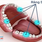 Niềng răng khi mất răng số 6 có khả thi không?