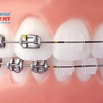 Thời gian dịch chuyển răng khi niềng răng bao lâu?