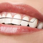 Niềng răng xong đeo hàm duy trì bao lâu để hiệu quả?