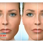 Mặt Lệch Có Thể Khắc Phục Bằng Niềng Răng? Khám Phá Ngay!
