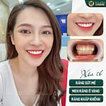 Niềng răng khểnh có đau không? Những điều cần biết ngay!