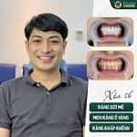 Giải pháp hiệu quả cho niềng răng khểnh hàm dưới tại nhà